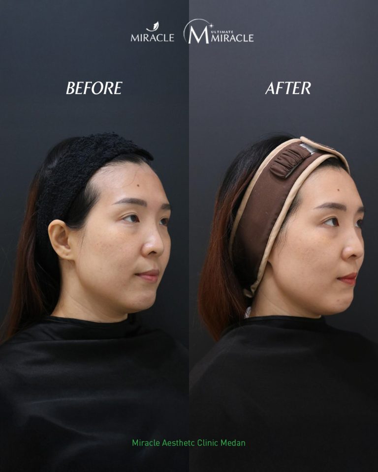 Kulit Lebih Cerah dan Merata, Pendekatan Personal Miracle Aesthetic Clinic untuk Atasi Flek dan Melasma